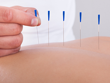 Acupuntura