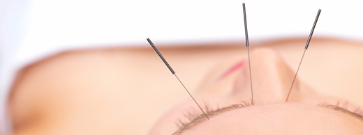 ACUPUNTURA